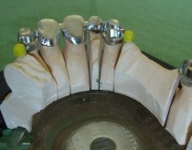 Combined prosthesis