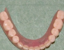 Mini implants anchored removable full lower denture